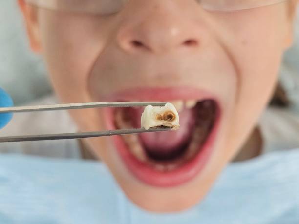 Best Emergency Treatment for Oral Infections in Collegedale, TN